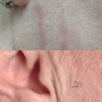 Блефаропластика возле ушей, и частично на лице