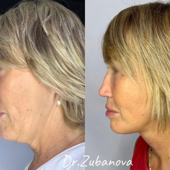 Фото з портфоліо фахівця Тетяна Зубанова (пластичний хірург, Луцьк)