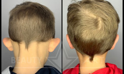 Отопластика Пластичний хірург Тетяна Луцьк