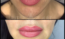 Хейлопластика Пластичний хірург Тетяна Луцьк