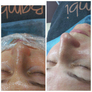 Чистка обличчя + Альгінатна маска у подарунок!
                    Косметолог Лілія Винница