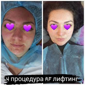 RF ліфтинг на апараті Zemits
                    Косметолог Лілія Винница