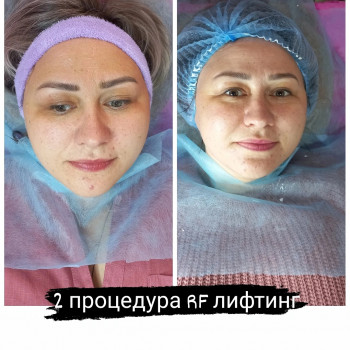 RF ліфтинг на апараті Zemits
                    Косметолог Лілія Винница