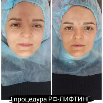 RF ліфтинг на апараті Zemits
                    Косметолог Лілія Винница