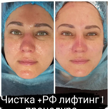 RF ліфтинг на апараті Zemits
                    Косметолог Лілія Винница