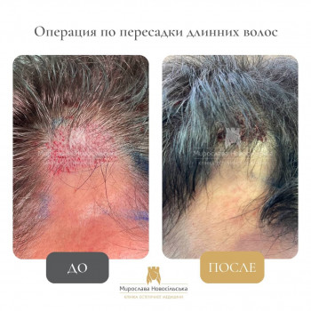 Трансплантація довгого волосся фото до/після