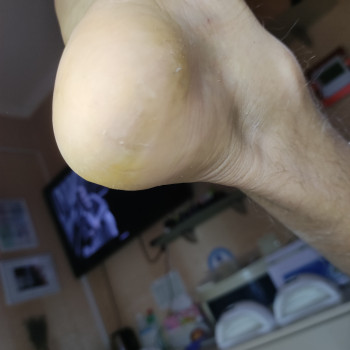 результат обработки глубоких трещин