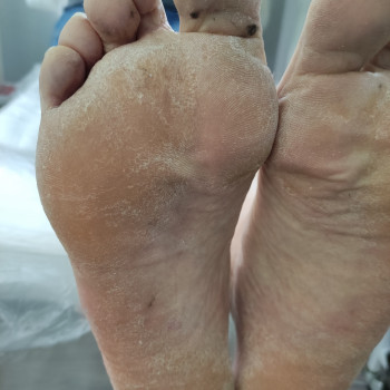 микозное поражение стоп и ногтей