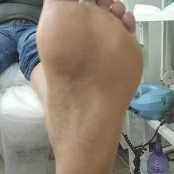 Результат первой обработки грибковог поражения стоп. Взят ан