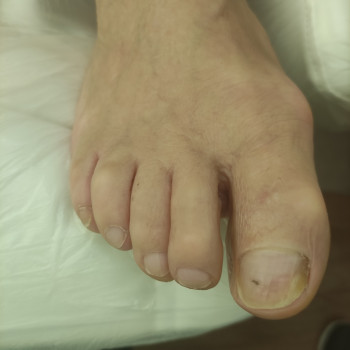 Зачистка микоза на ногтях