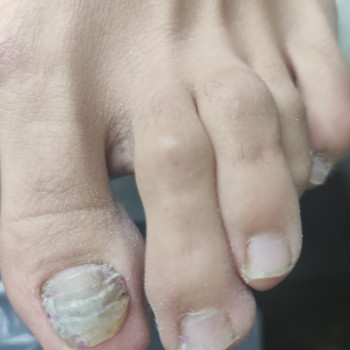 Травма большого пальца