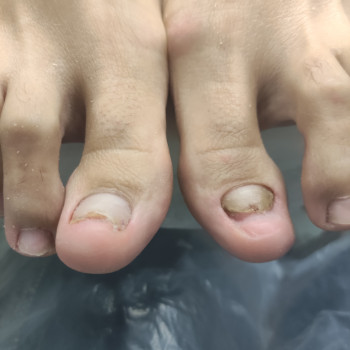 проведена зачистка, в последующем установка титановой нити