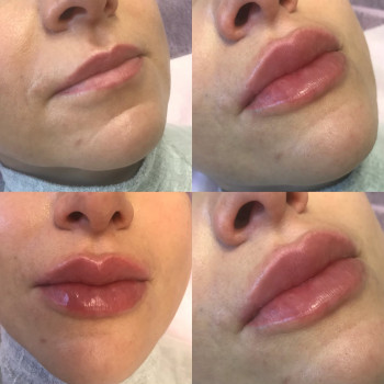 Увеличение губ.