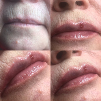 Увеличение и омоложение возрастных губ.