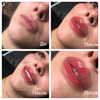 Увеличение губ.