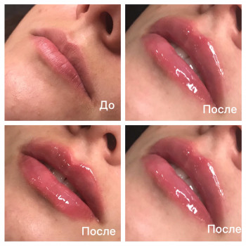 Увеличение губ.