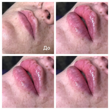 Увеличение губ.