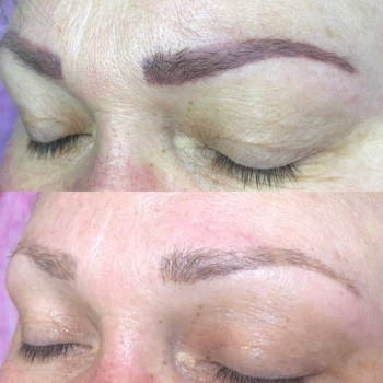 Лазерное удаление тату и татуажа
                    Салон краси Confetti Харків