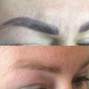 Лазерное удаление тату и татуажа
                    Салон краси Confetti Харків