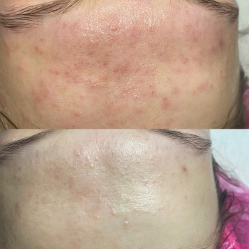 Чистка обличчя