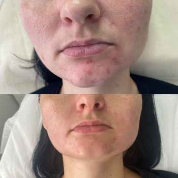 Лікування вугрової хвороби