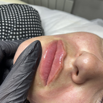 Контурна пластика губ