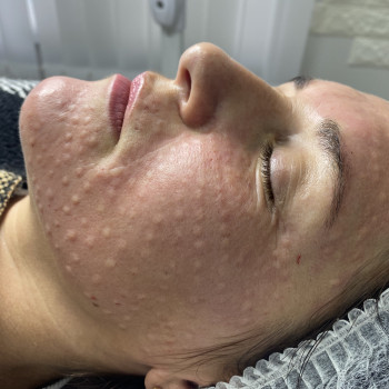 Біоревіталізація