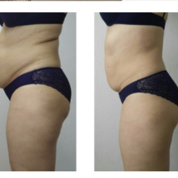 Апаратна корекція фігури Стратосфера