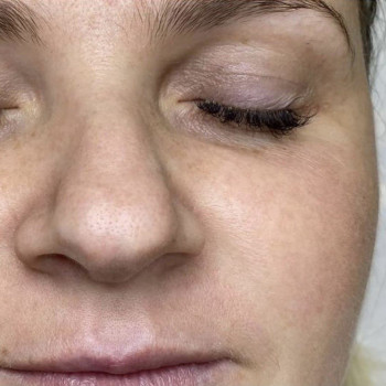 лазерне видалення веснянок - фото "після" процедури