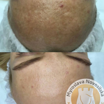 лазерне видалення пігментних плям