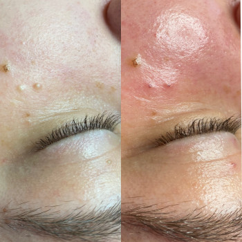 Чистка обличчя