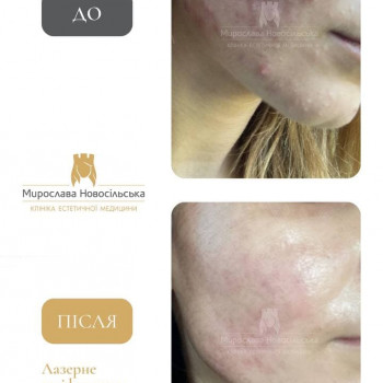 Лазерна шліфовка шкіри у Львові