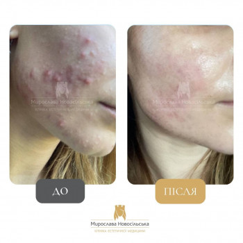 Лікування проблемної шкіри лазерним шліфуванням. Фото до/піс