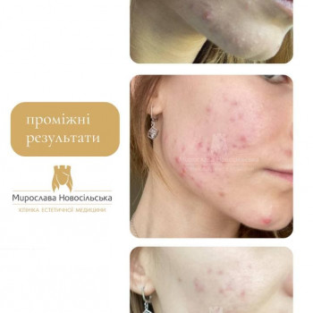 Лазерне шліфування фото до/піся