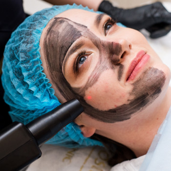 Карбоновий пілінг