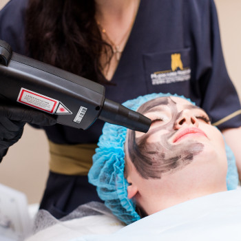 Карбоновий пілінг