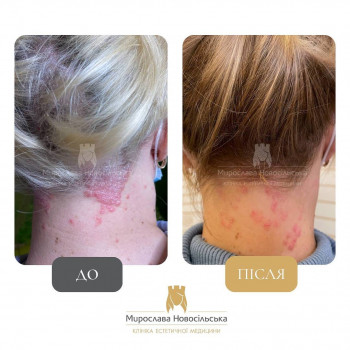Лікування псоріазу лазером у Клініці естетичної медецини Мир