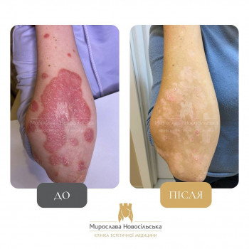 Лазерне лікування псоріазу на руках