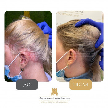 Лікування псоріазу лазером на голові фото до/після