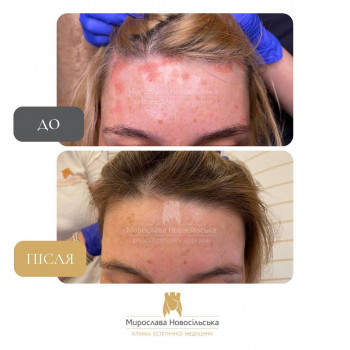 Лікування псоріазу на обличчі