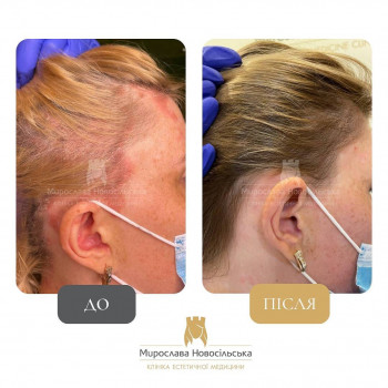 Лікування псоріазу лазером на волосяній частині голови. фото