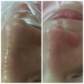 Чистка обличчя + Альгінатна маска у подарунок!
                    Косметолог Лілія Винница