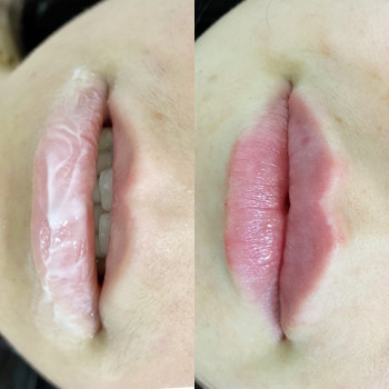 Збільшення губ
                    Стоматолог Ирина Луцк