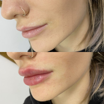 Збільшення губ
                    Стоматолог Ирина Луцк