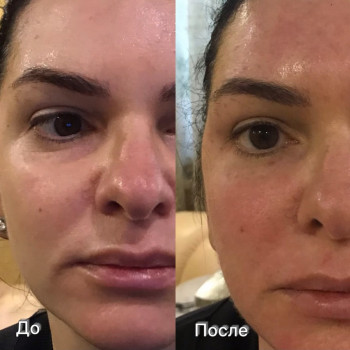 Биоревитализация