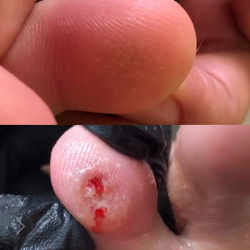 Удаление бородавки жидким азотом.
Динамика после двух удале