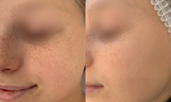 Аппарат Nordlys Candela Лечения пигментации, капилярных сеток, веснушек Косметолог Галина Николаевна Ровно