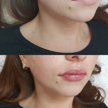 Филлер Швейцария 1мл средней плотности