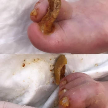 Зачистка нігтьової пластини.