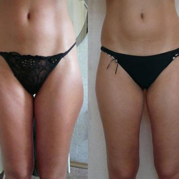 Липолитики по телу